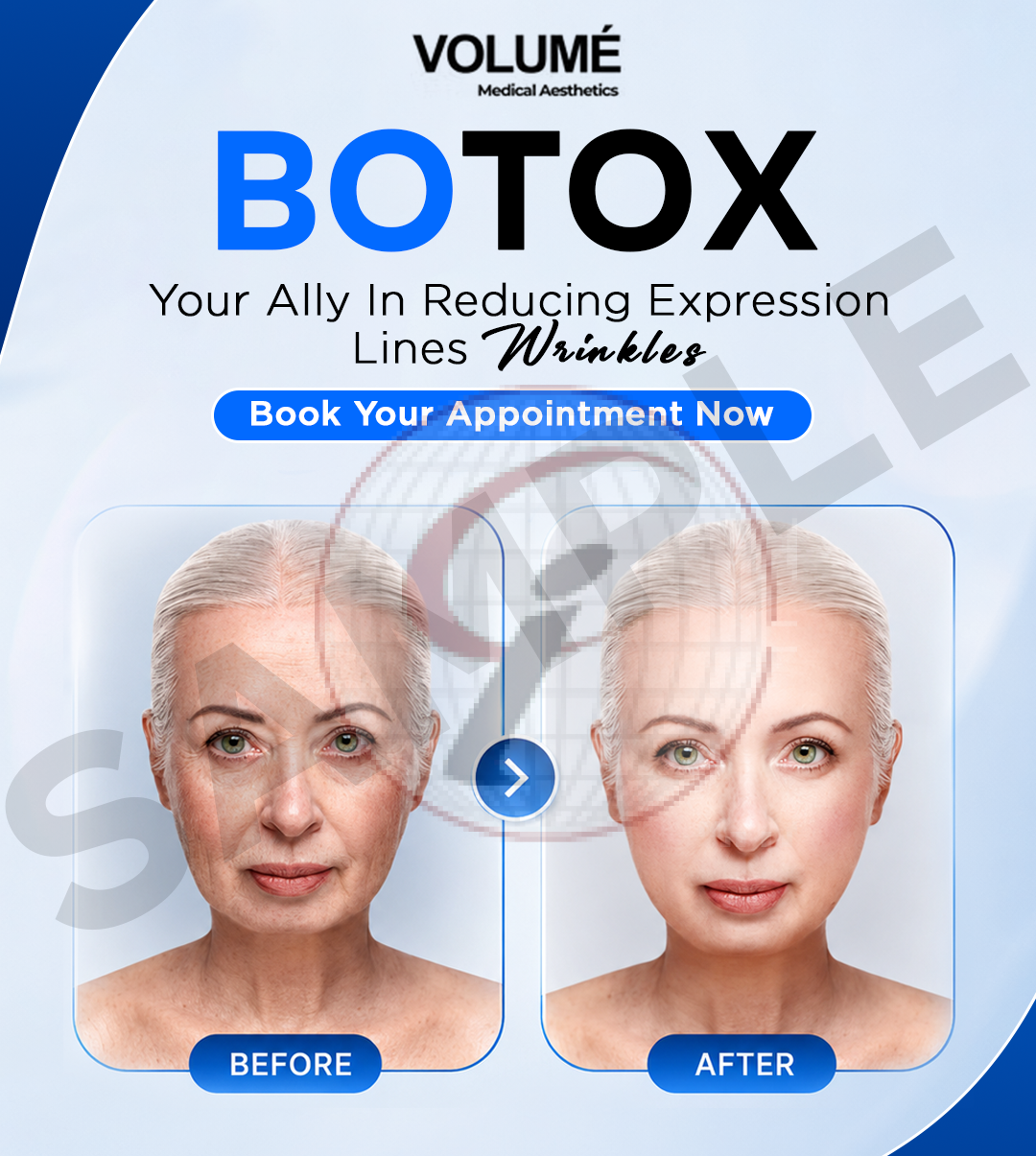 Botox