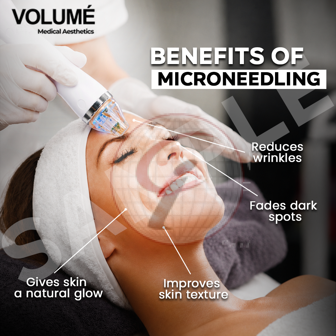 Benefits Of Microneedling